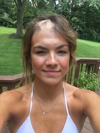 christie alopecie 4