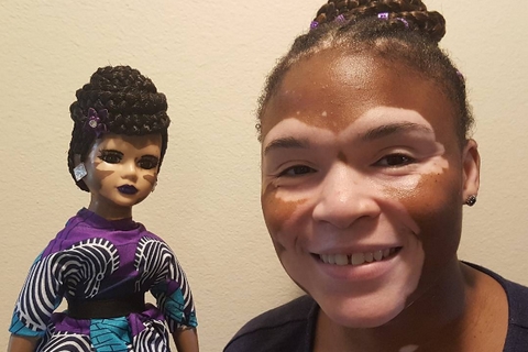 Obrázek: panenky-vitiligo-small