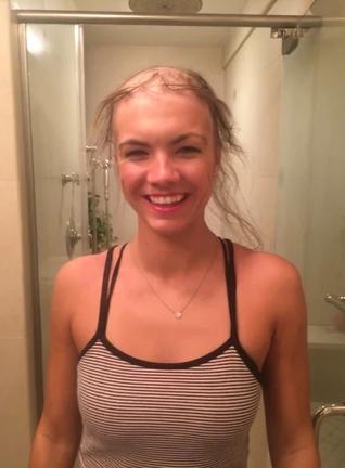 christie alopecie 5