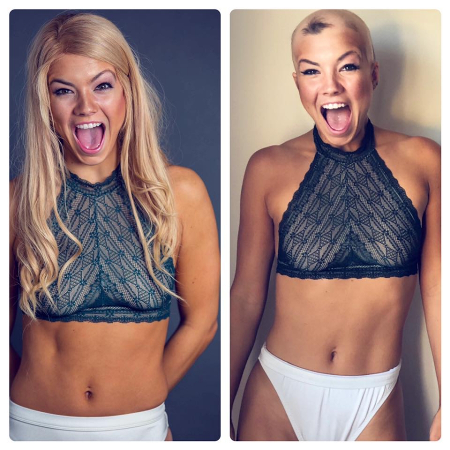 christie alopecie 3