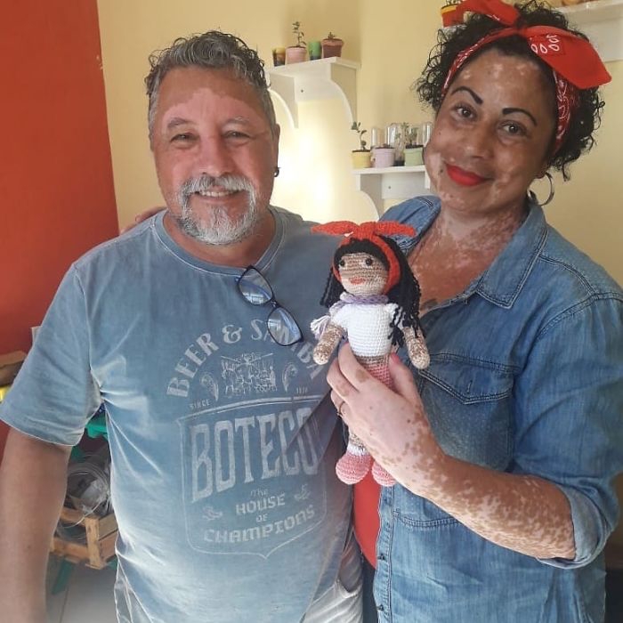 vitiligo dedecek 1