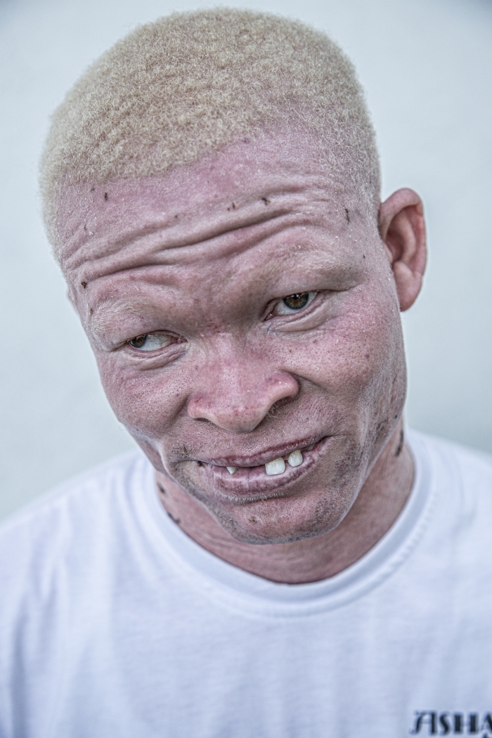 richard albinismus 1
