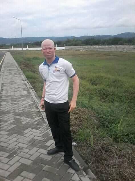 richard albinismus 2
