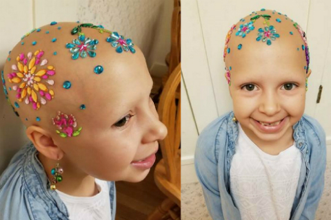 Obrázek: alopecia-small
